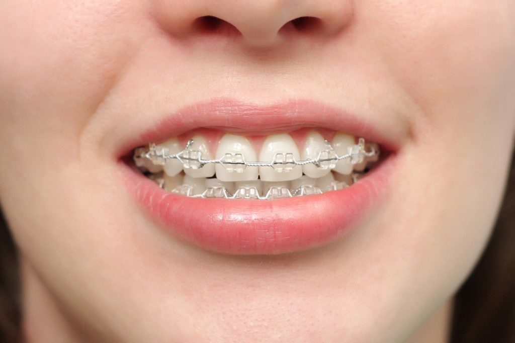 dec16-326(2)_orthodontie_adulte